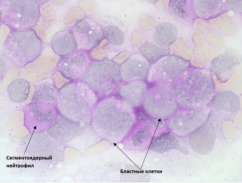 Бластные клетки. Бластные клетки морфология. Бластные клетки микроскопия. Бластные клетки 2.
